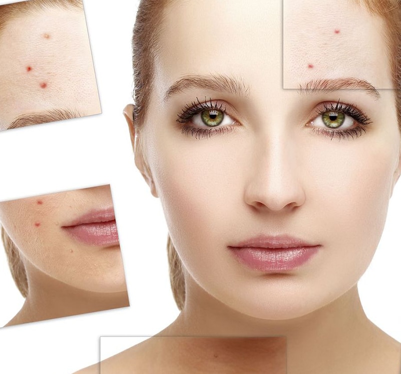 acne-et-peau-grasse-clinique-soins-corps