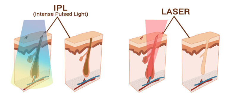 Différence entre les techniques laser et l'IPL