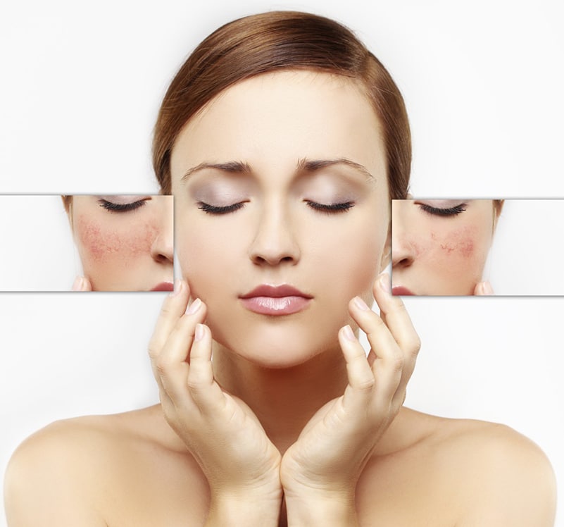 peau-sensible-et-couperosee-clinique-soins-corps
